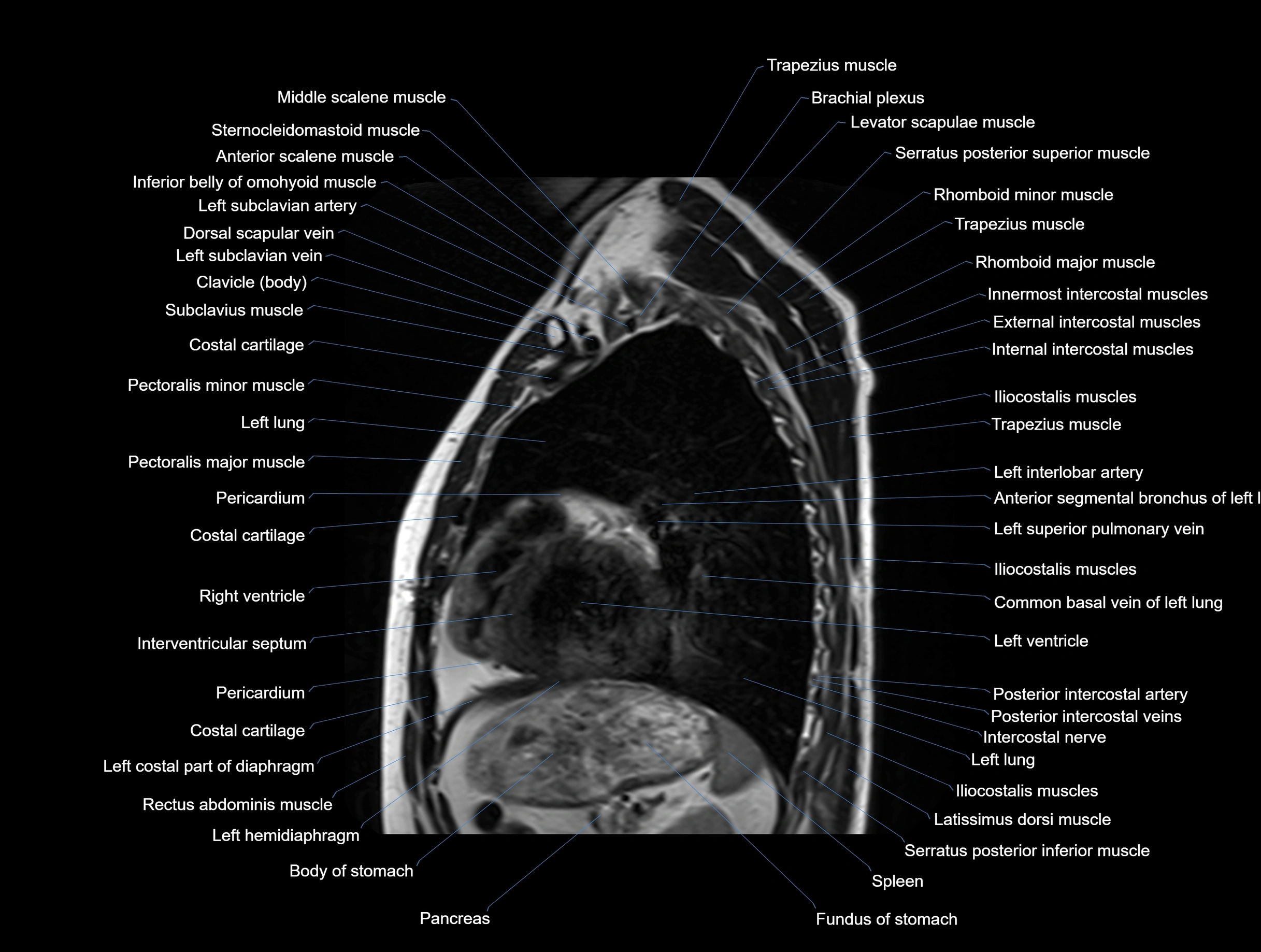 MRI chest (thorax) coronal  cross sectional anatomy 3T radiology  image-img-00001-00026.webp